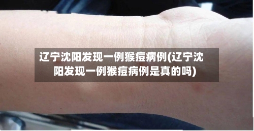 辽宁沈阳发现一例猴痘病例(辽宁沈阳发现一例猴痘病例是真的吗)