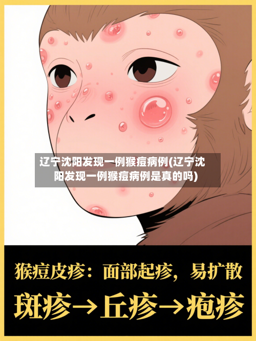 辽宁沈阳发现一例猴痘病例(辽宁沈阳发现一例猴痘病例是真的吗)-第2张图片